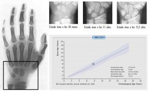 imagen con resultados de la resonancia según las diversas edades y la posterior equivalencia de edad ósea y física según la gráfica de Greulich y Pyle